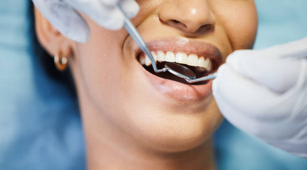 Best Urgent Care for Lost Fillings or Crowns in Edmonds, WA