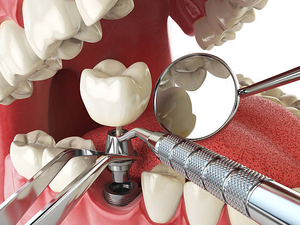 Best Emergency Dental Care for Broken or Chipped Teeth in Edmonds, WA